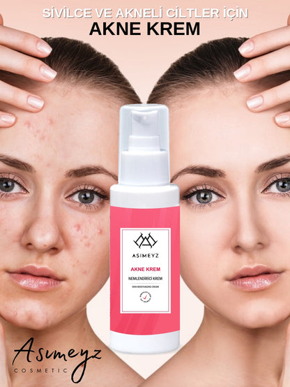 Sivilce Önleyici Ve Sivilce Karşıtı Akne Siyah Nokta Giderici Nemlendirici Krem Anti-Acne 150 ml